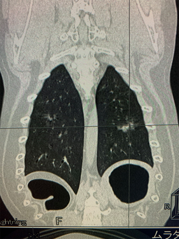 CT　コロナル像　画像