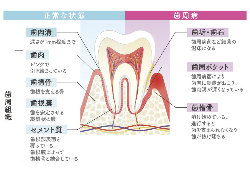 正常な歯と歯周病