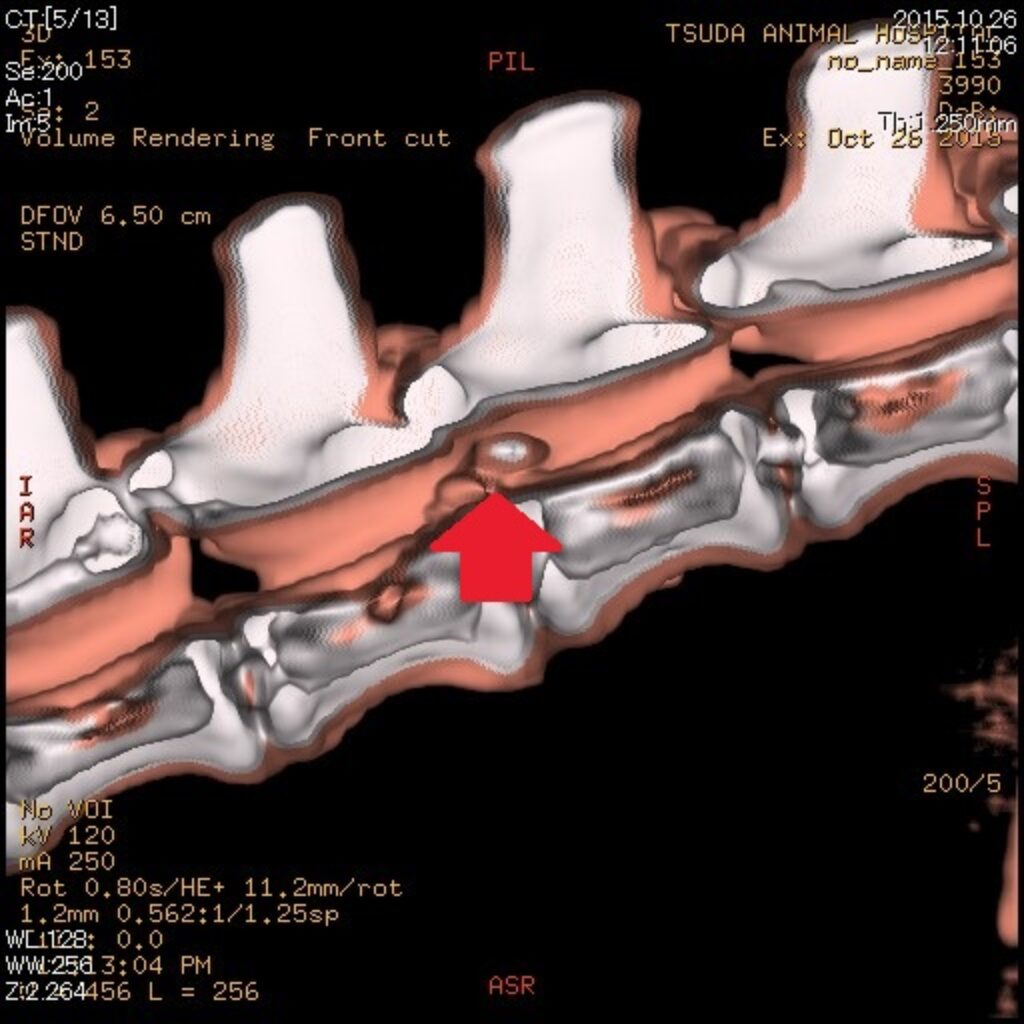 椎間板ヘルニア